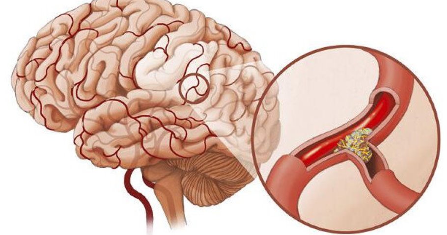 جەڵتەی مێشکی ئیسکیمیک
