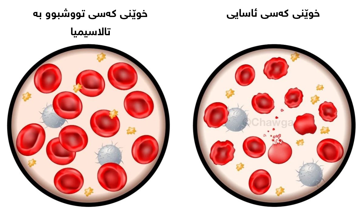جیاوازی پێکهاتەی خوێنی ئاسایی و خوێنی کەسی تووشبوو بە تالاسیمیا
